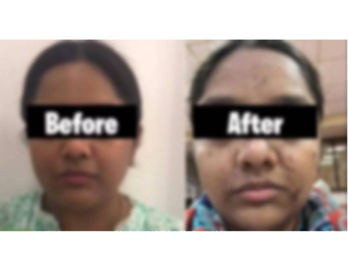 17 हजारांचे फेशिअल महागात पडले, मुंबईतील महिलेचा संपूर्ण चेहराच बिघडला